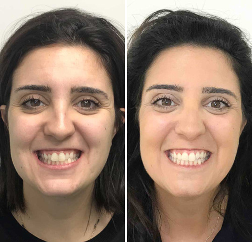 نتائج علاج تقويم الأسنان الشفاف قبل وبعد بسمة