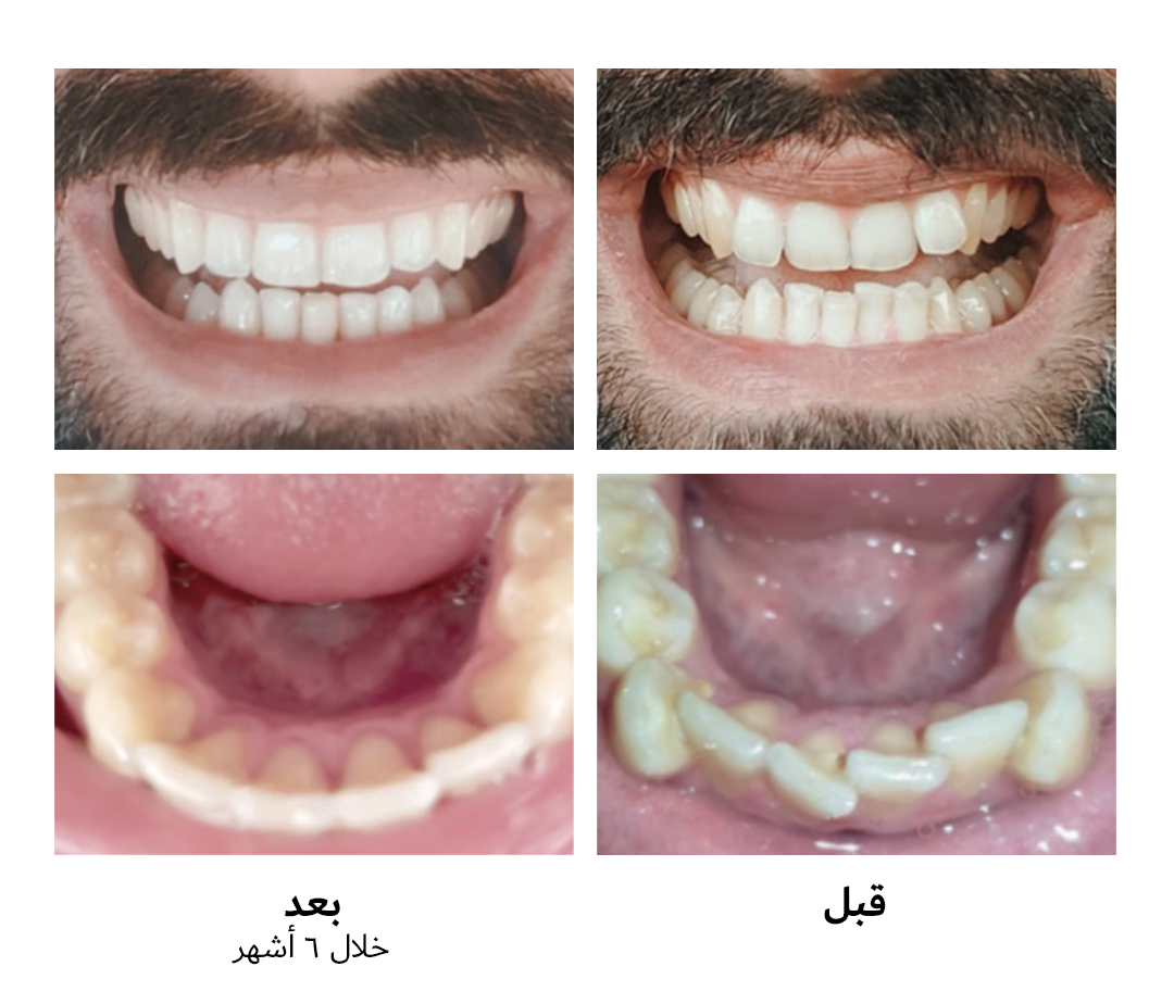 صورة أسنان لعميل تظهر تحسّن أسنانه قبل وبعد تقويم الأسنان الشفاف من بسمة