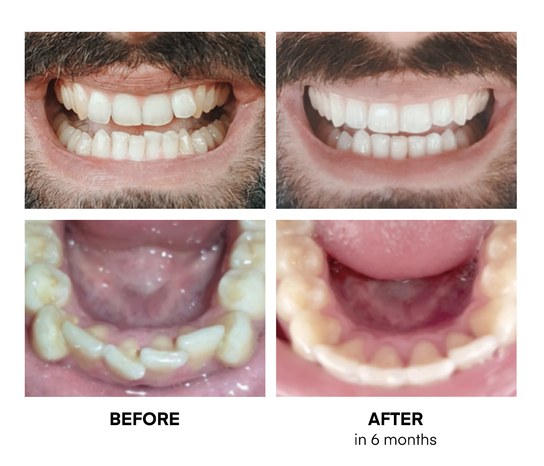 Dental picture of a client showing his teeth improvement before and after transparent braces from Basma