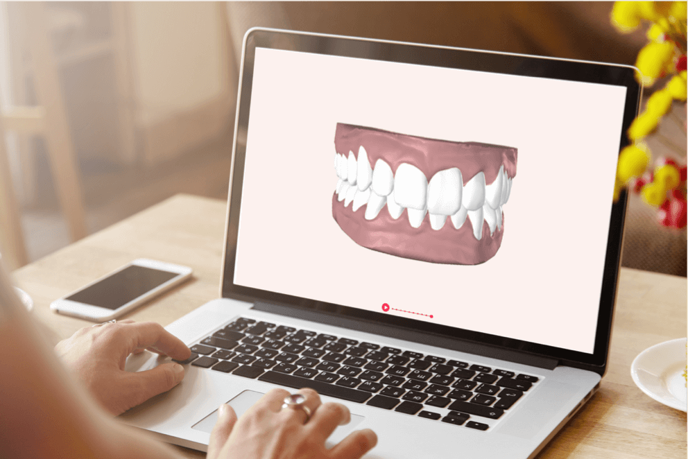 Laptop screen showing a 3D scan of a patient's teeth