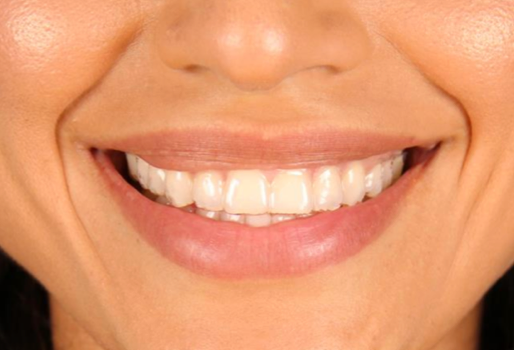 Close-up of a patient's teeth, smiling while wearing BASMA aligners